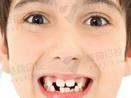 窝沟封闭时间长是什么样子,窝沟封闭涂氟时间(图1)